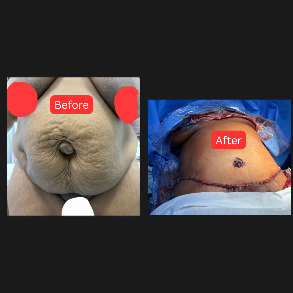 Abdominoplasty