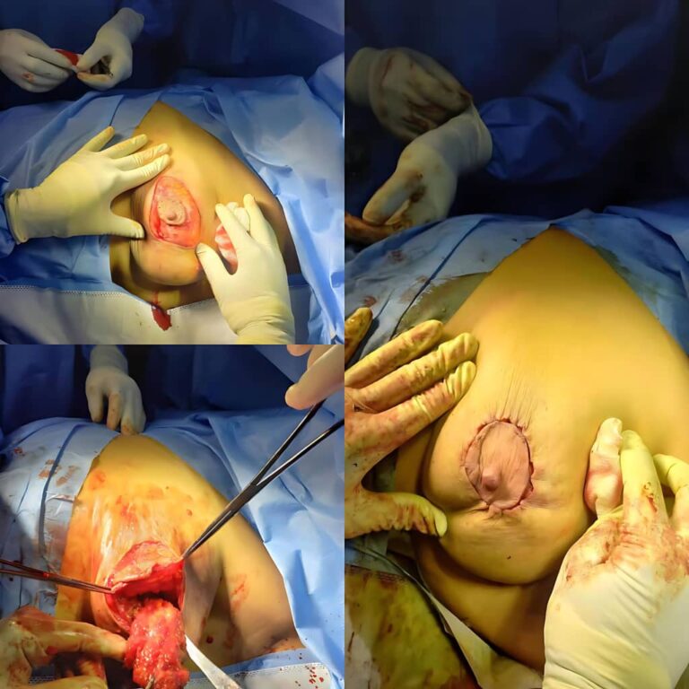 Breast Oncoplastic Surgery